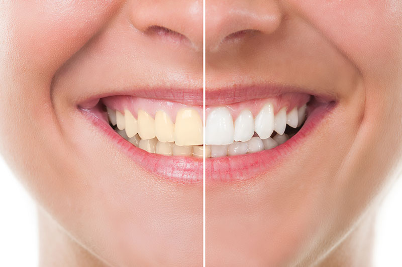 Teeth Whitening - Elston Dental , Chicago Dentist